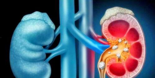 肾结石可以吃白瓜吗,白瓜的适宜摄入与注意事项